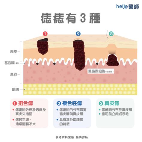 身體 痣|痣變大、痣多或長毛會變皮膚癌？認識痣的形成與原因